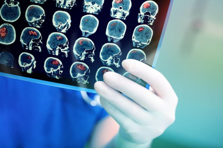 15 Things Neurologists Do To Prevent Alzheimers Disease 1